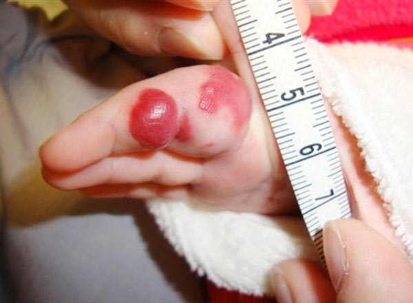 Säugling mit einem progredienten, roten, pulsatilen Tumor am Finger