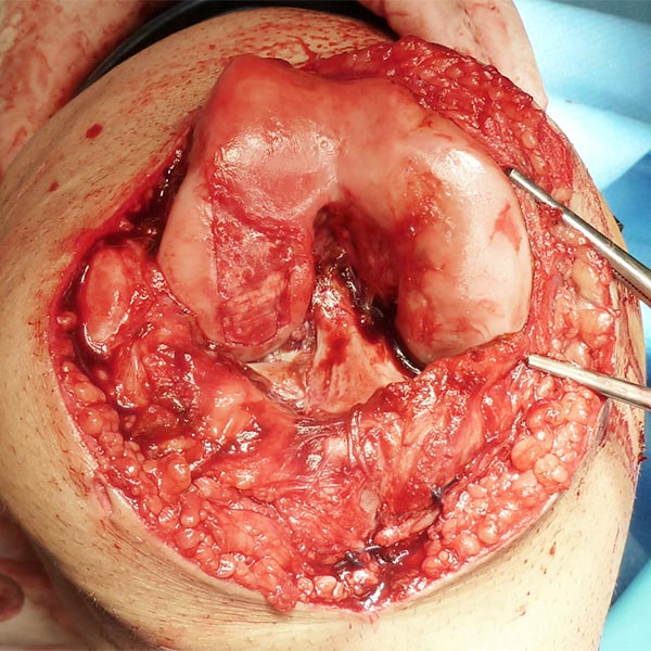 Operation – Venöse Malformation an Knie