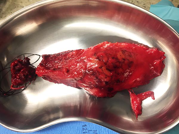 Resektat – Fibro Adipose Vascular Anomaly an Wade