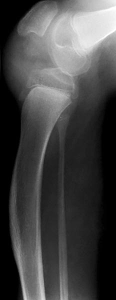 Röntgenbild – Kniegelenkskontraktur bei progrdientem PTEN-Hamartom