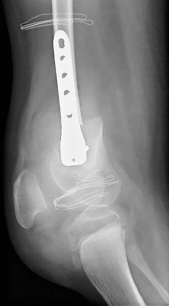 Röntgenbild – Kniegelenkskontraktur bei progrdientem PTEN-Hamartom