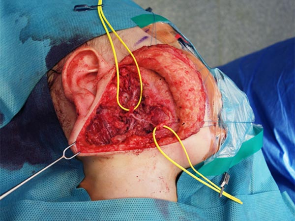 Operation – Lymphatische Malformation der Parotis