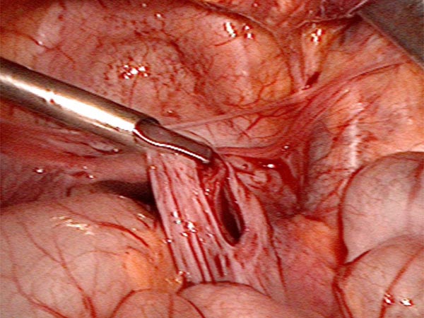 Laparoskopische Resektion – Retroperitoneale lymphatische Malformation