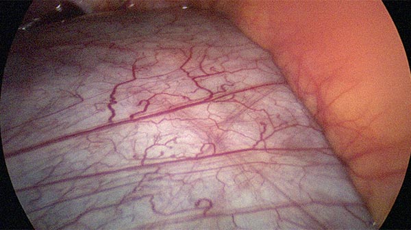 Laparoskopische Resektion – Retroperitoneale lymphatische Malformation