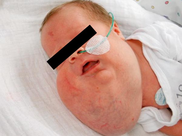 Lymphatische Malformation – Gesicht