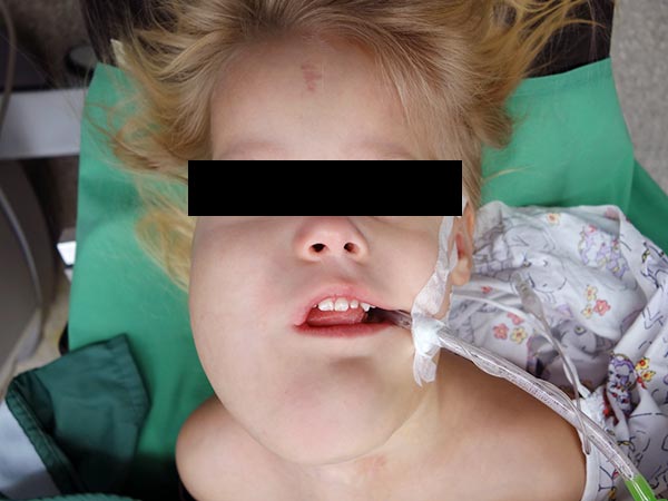 Lymphatische Malformation Gesicht – vor erneuter Operation