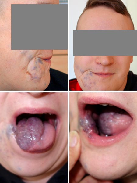 Venöse Malformation – Mund- Rachenraum – nach Therapie