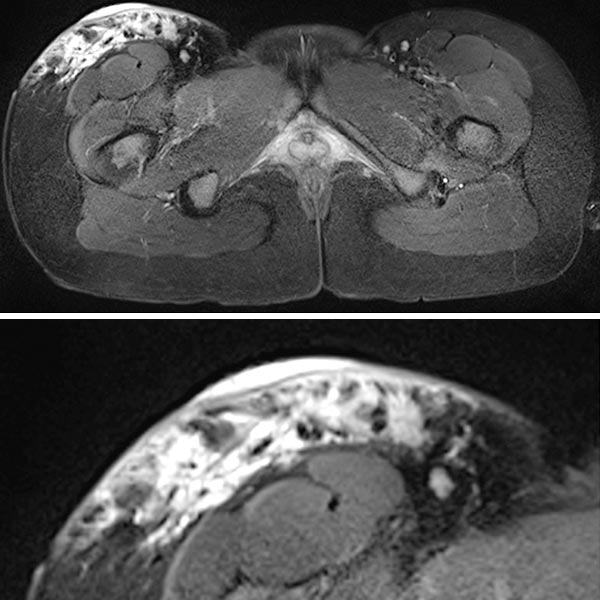 MRT T2 Wichtung – Lymphatische Malformation