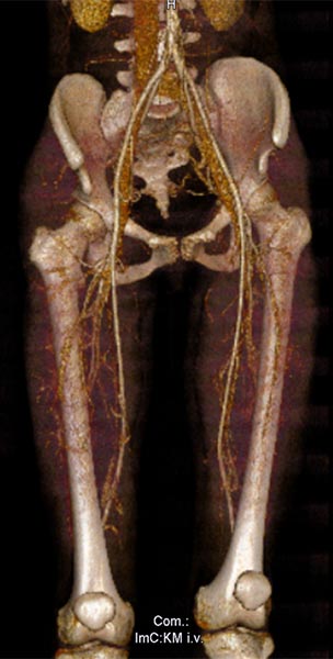 3D-Angiographie – Lymphatische Malformation