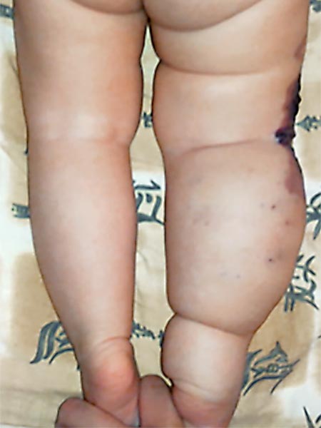 Klippel-Trénaunay-Syndrom, Lymphorrhoe am Bein