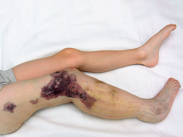 Nach Sklerosierung – Klippel-Trénaunay-Syndrom, Lymphorrhoe am Bein