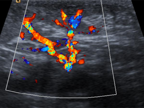 Sonographie – Non-Involuting Congential Hemangioma