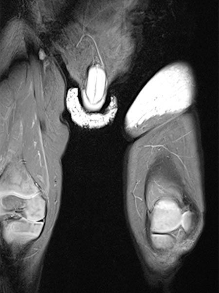 MRT – Non-Involuting Congential Hemangioma