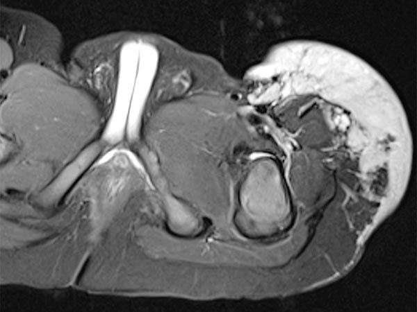 MRT – Non-Involuting Congential Hemangioma