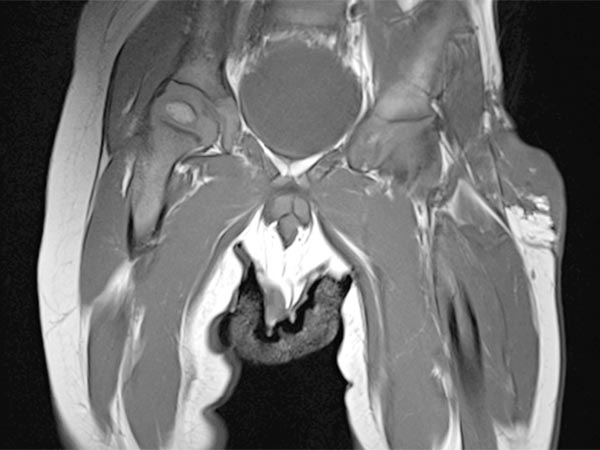 MRT – Non-Involuting Congential Hemangioma