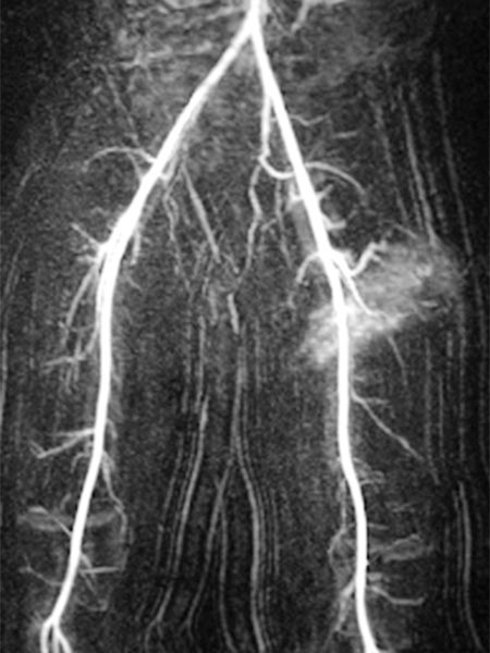 MR-Angiographie – Non-Involuting Congential Hemangioma (30s)