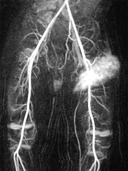 MR-Angiographie – Non-Involuting Congential Hemangioma (41s)