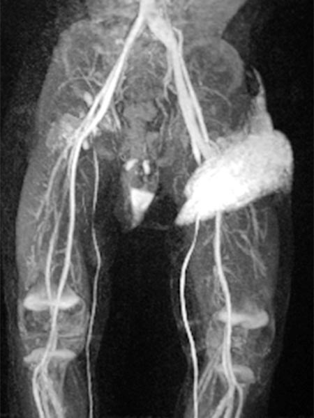 MR-Angiographie – Non-Involuting Congential Hemangioma (130s)