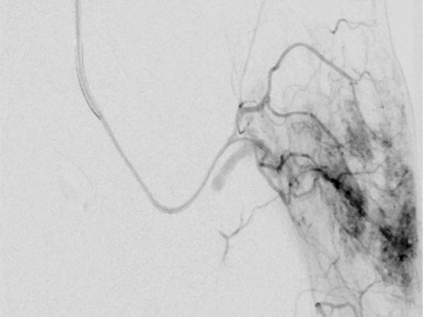 Digitale Subtraktionsangiographie – Non-Involuting Congential Hemangioma