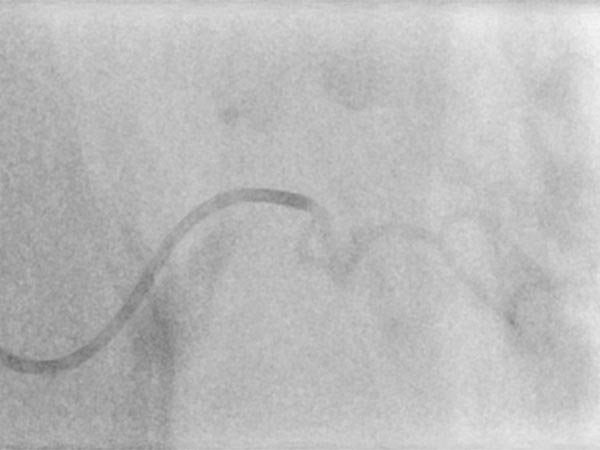 Digitale Subtraktionsangiographie – Non-Involuting Congential Hemangioma