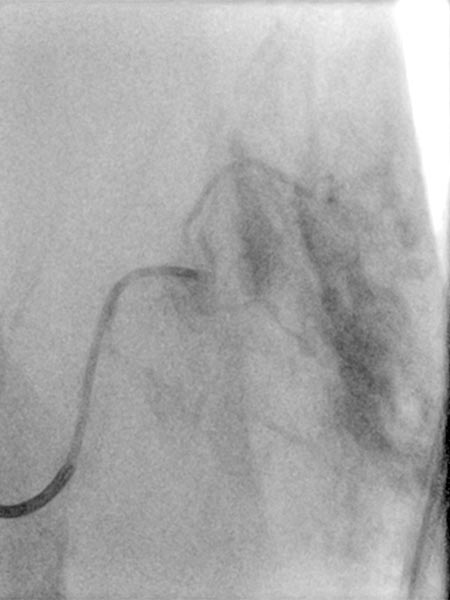 Embolisation – Non-Involuting Congential Hemangioma