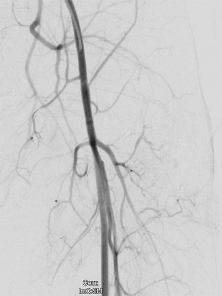 Angiographie – Non-Involuting Congential Hemangioma