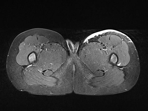 MRT – Non-Involuting Congential Hemangioma – Tumor in der linken Leiste 3 Jahre nach Therapie