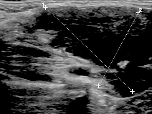 Sonographie – Venöse Malformation am Hals