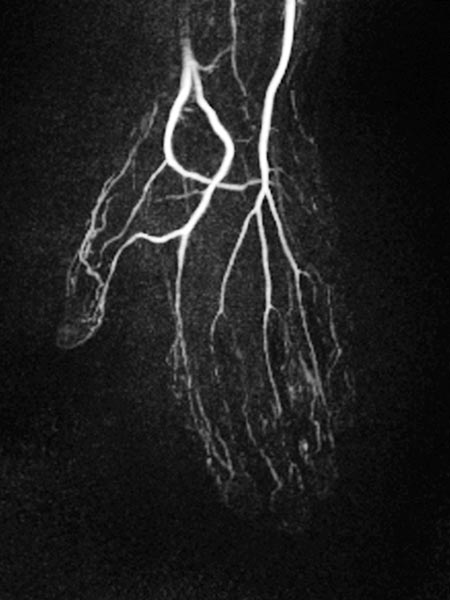 Angiographie – Venöse Malformation an Hand