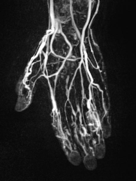 Angiographie – Venöse Malformation an Hand
