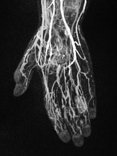 Angiographie – Venöse Malformation an Hand