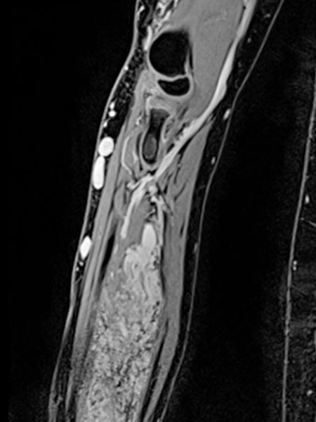MRT – Venöse Malformation an UnterarmT1-gewichtete, fettgesättigte KM-unterstützte MRT-Sequenz des Unterarmes. Man sieht klar das komplette Enhancement der Malformation in der Muskulatur. Damit handelt es sich um eine venöse Malformation. Einige etwas vergrößerte, dysplastische Venen finden sich auch lateral am proximalen Unteram epifaszial im subkutanen Fettgewebe.