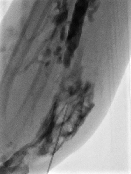 Sklerosierung – Venöse Malformation an Unterarm