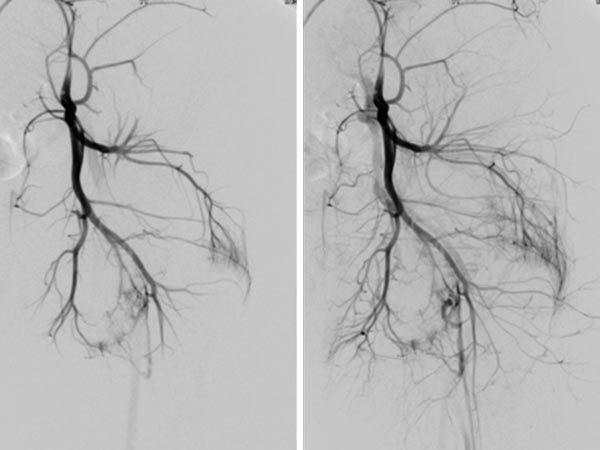 Digitale Subtraktionsangiographie – Parkes-Weber-Syndrom am Bein