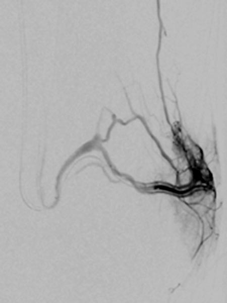 Digitale Subtraktionsangiographie – Parkes-Weber-Syndrom am Bein