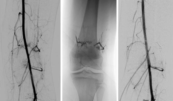 Embolisation – Parkes-Weber-Syndrom am Bein