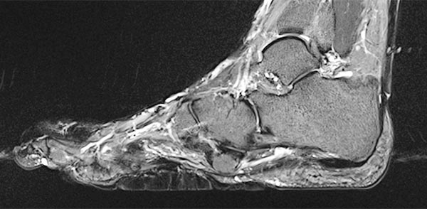 MRT – Proteus-Syndrom