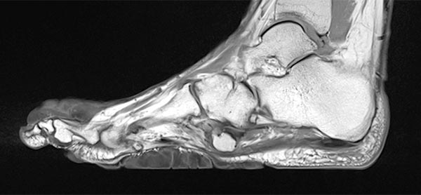 MRT – Proteus-Syndrom