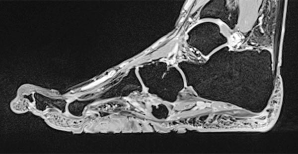 MRT – Proteus-Syndrom