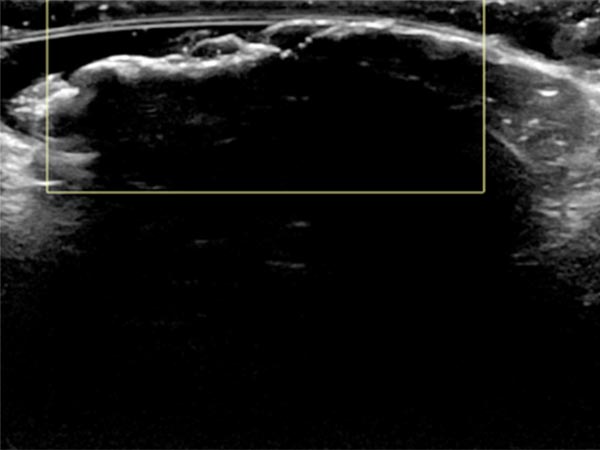 Farbkodierte Duplexsonographie – Proteus-Syndrom