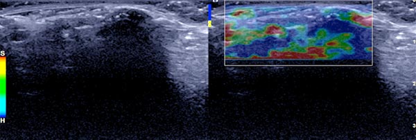 Ultraschall-Elastographie – Proteus-Syndrom