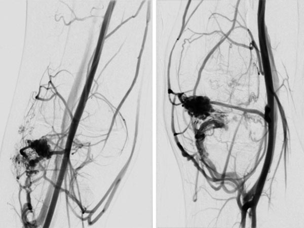 DSA – PTEN-Hamartom-Syndrom am Knie