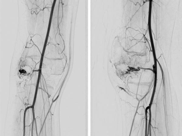 DSA – PTEN-Hamartom-Syndrom am Knie