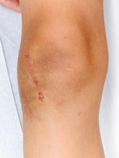 PTEN-Hamartom-Syndrom am Knie nach Resektion