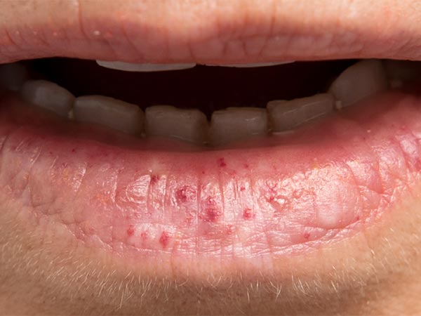 HHT · Morbus Osler Osler Spots an Unterlippe