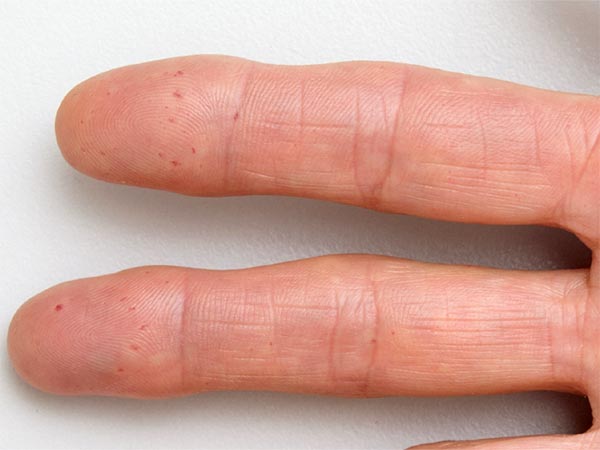 HHT · Morbus Osler Osler Spots an Finger