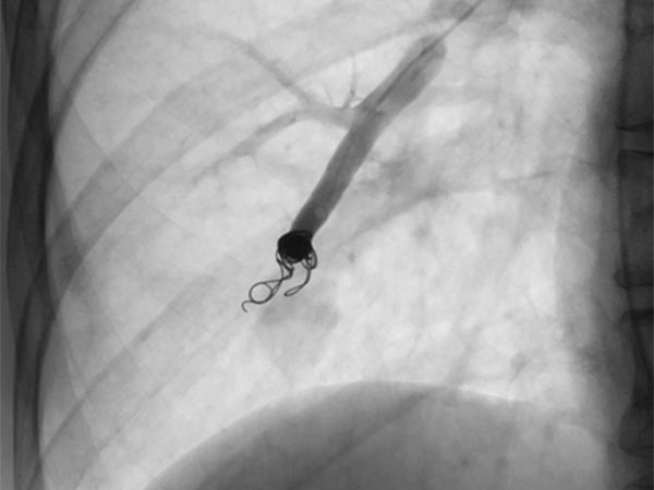 HHT · Morbus Osler Digitale Subtraktionsangiographie – pulmonale AVM