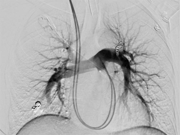 Digitale Subtraktionsangiographie – pulmonale AVM 