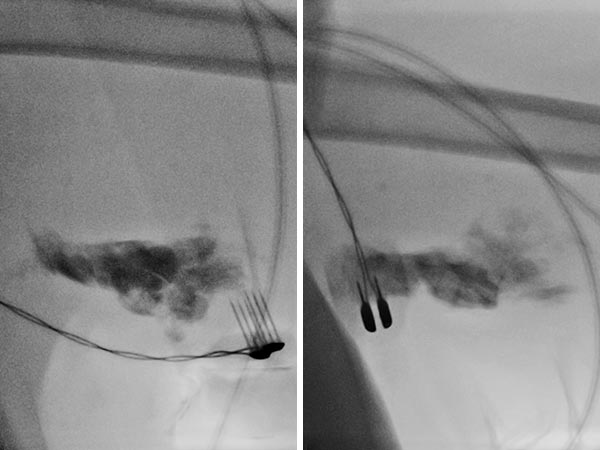 Elektrosklerotherapie – Stromimpulse durch Fingerelektrode