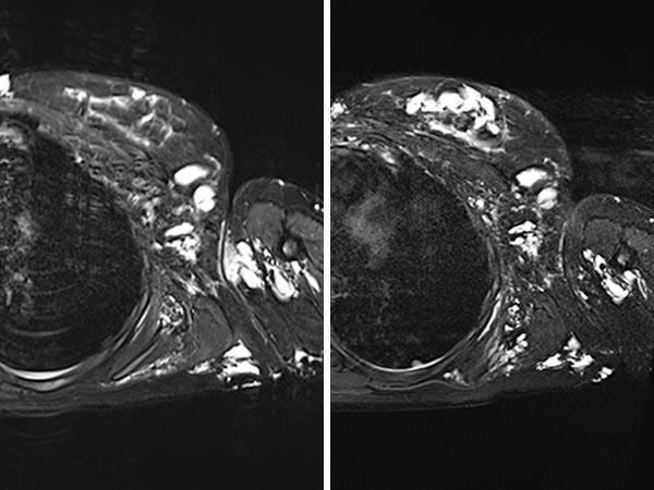 MRT – Die behandelten Anteile der lymphatischen Malformation sind stark geschrumpft